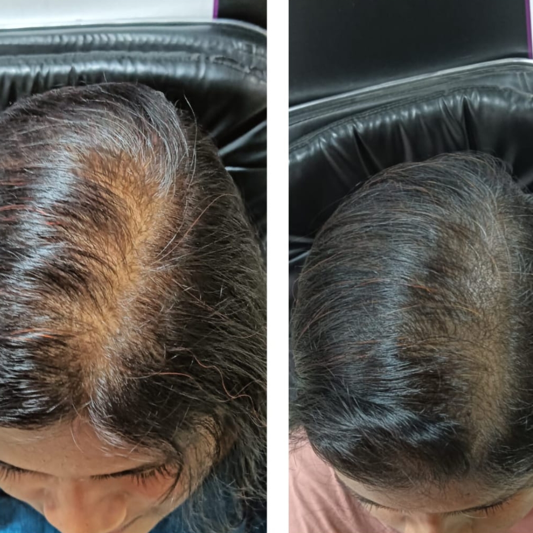 After treatment