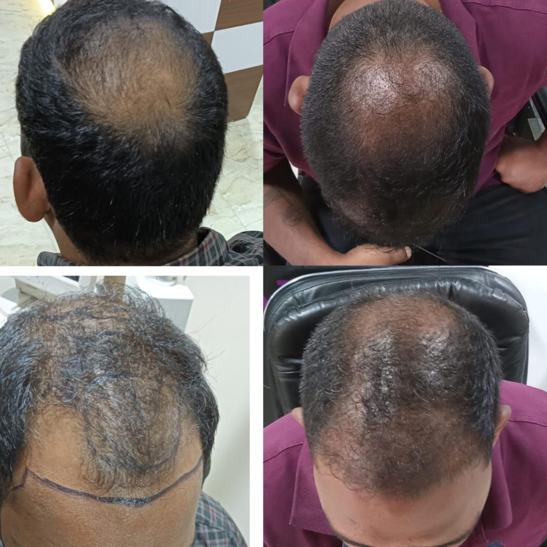 After treatment